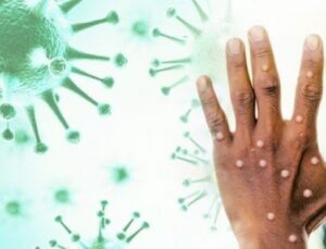 DSÖ Maymun Çiçeği Virüsü Nedeniyle Küresel Sağlık Krizi İlan Etti