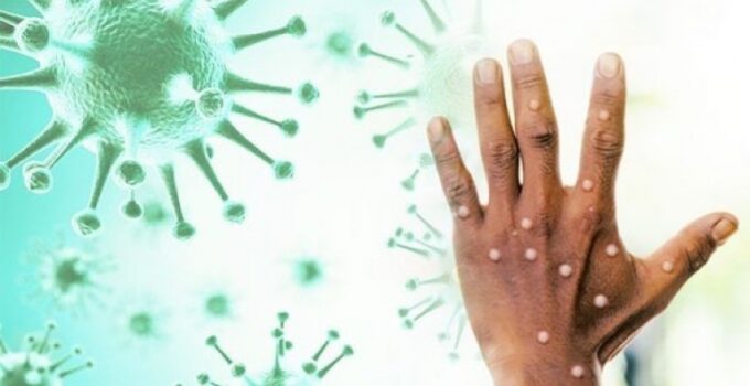 DSÖ Maymun Çiçeği Virüsü Nedeniyle Küresel Sağlık Krizi İlan Etti